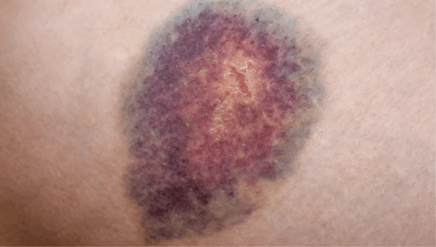 sintomas de leucemia