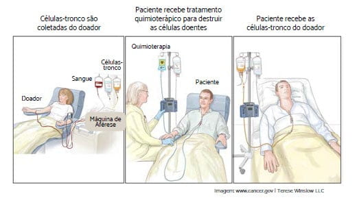 transplante_de_medula_ossea_para_mielofibrose