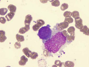 Imagem_microscópica_da_mielofibrose_aguda